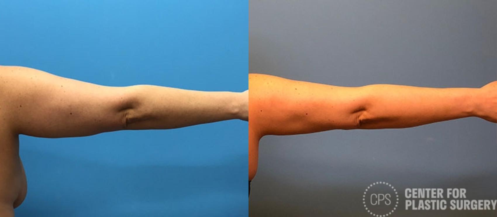 Arm Lift Before & After Photo | Annandale, Virginia | Center for Plastic Surgery