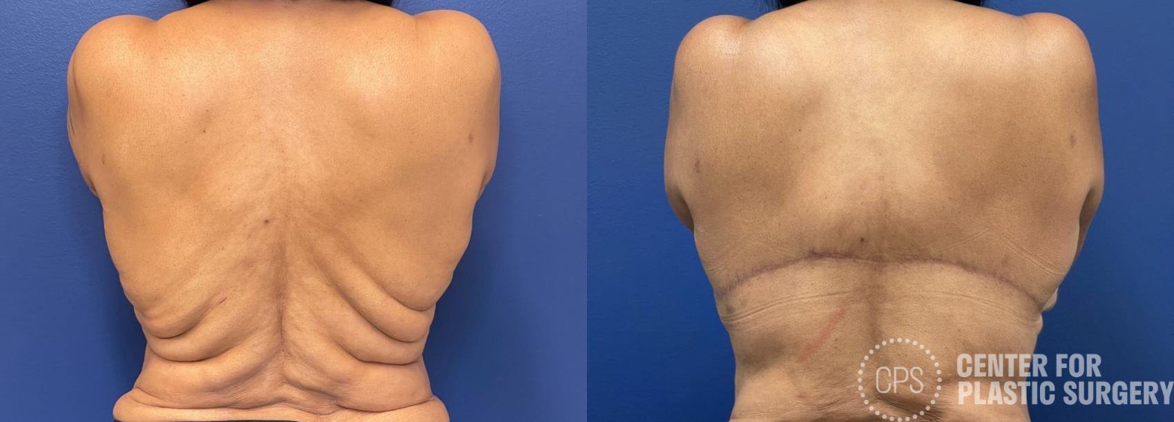 Body Lift Case 274 Before & After Back | Chevy Chase & Annandale, Washington D.C. Metropolitan Area | Center for Plastic Surgery