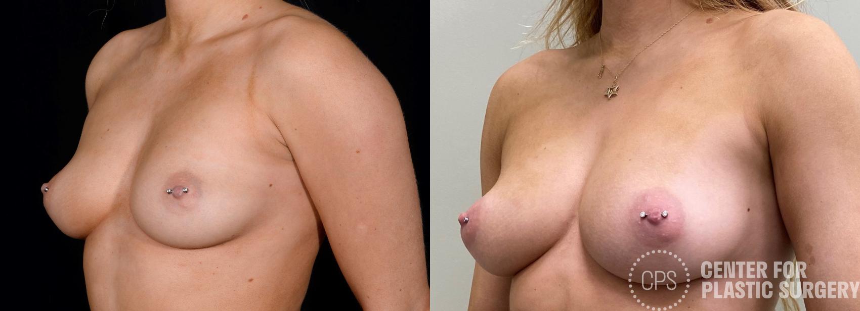Breast Augmentation Case 350 Before & After Left Oblique | Chevy Chase & Annandale, Washington D.C. Metropolitan Area | Center for Plastic Surgery