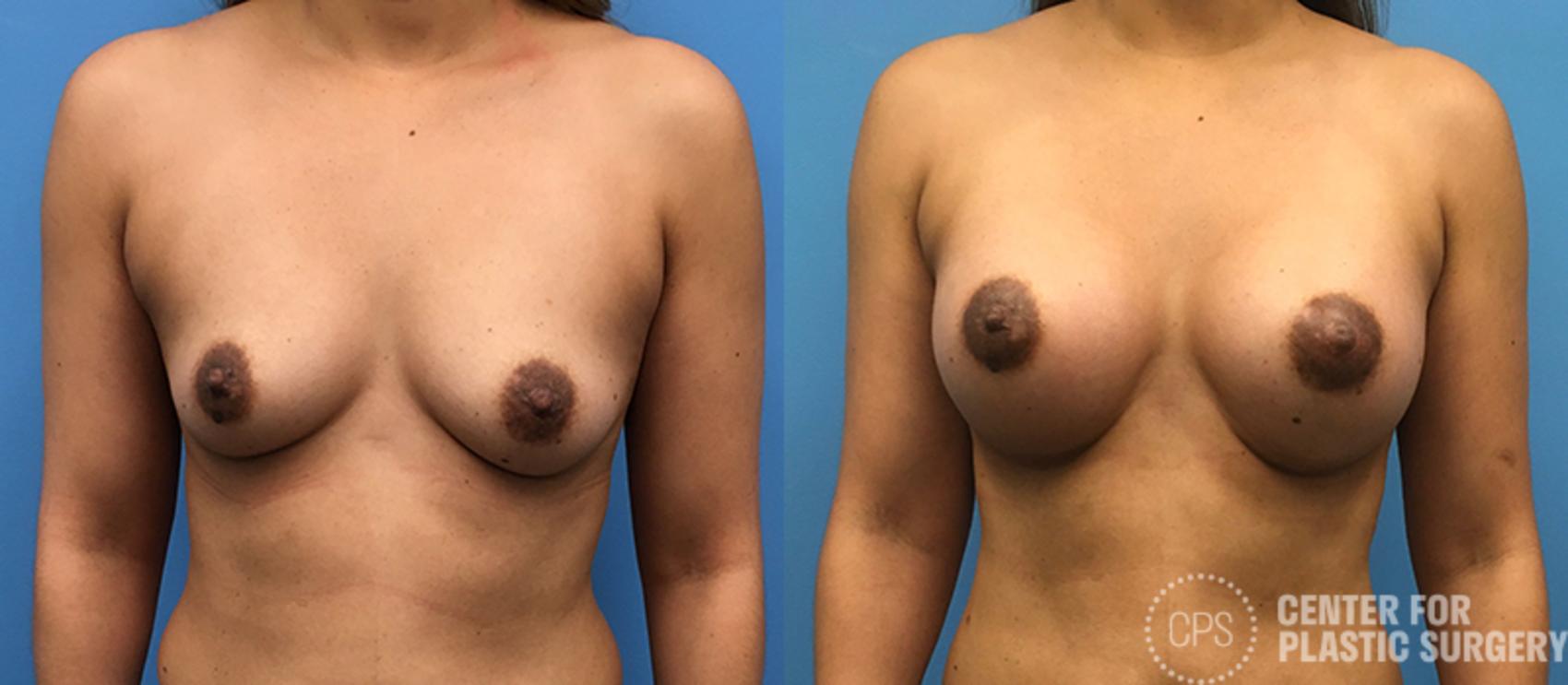 Breast Augmentation Case 95 Before & After Front | Chevy Chase & Annandale, Washington D.C. Metropolitan Area | Center for Plastic Surgery