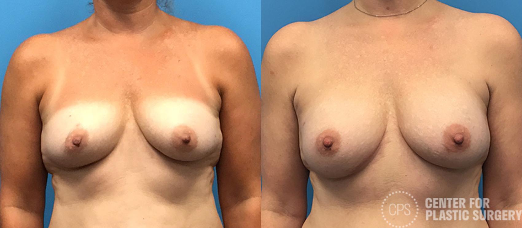 Breast Reconstruction Case 139 Before & After Front | Annandale, Washington D.C. Metropolitan Area | Center for Plastic Surgery