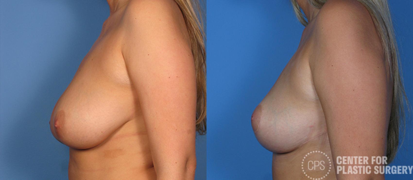 Breast Reduction Before & After Photo | Annandale, Virginia | Center for Plastic Surgery
