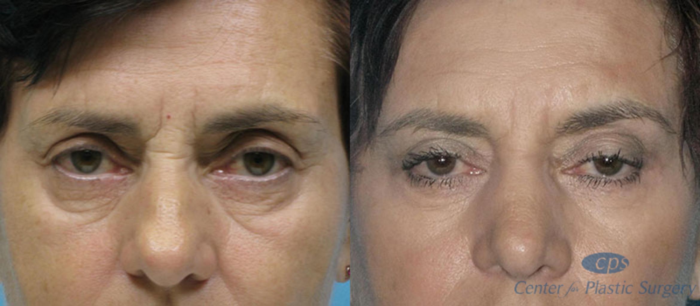 Eyelid Surgery Case 16 Before & After Front | Washington DC, Bethesda & Chevy Chase, Washington D.C. Metropolitan Area | Center for Plastic Surgery