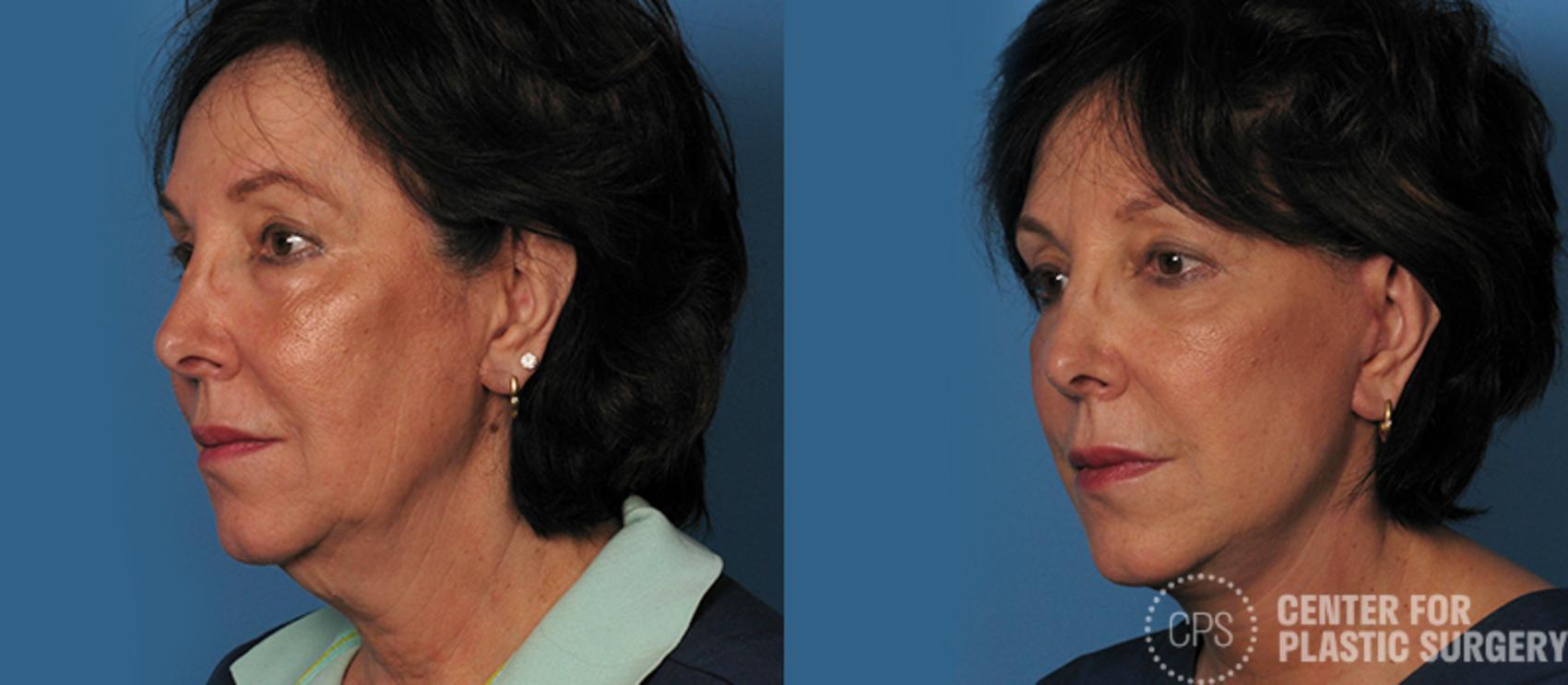 Facelift Case 4 Before & After Left Oblique | Annandale, Washington D.C. Metropolitan Area | Center for Plastic Surgery