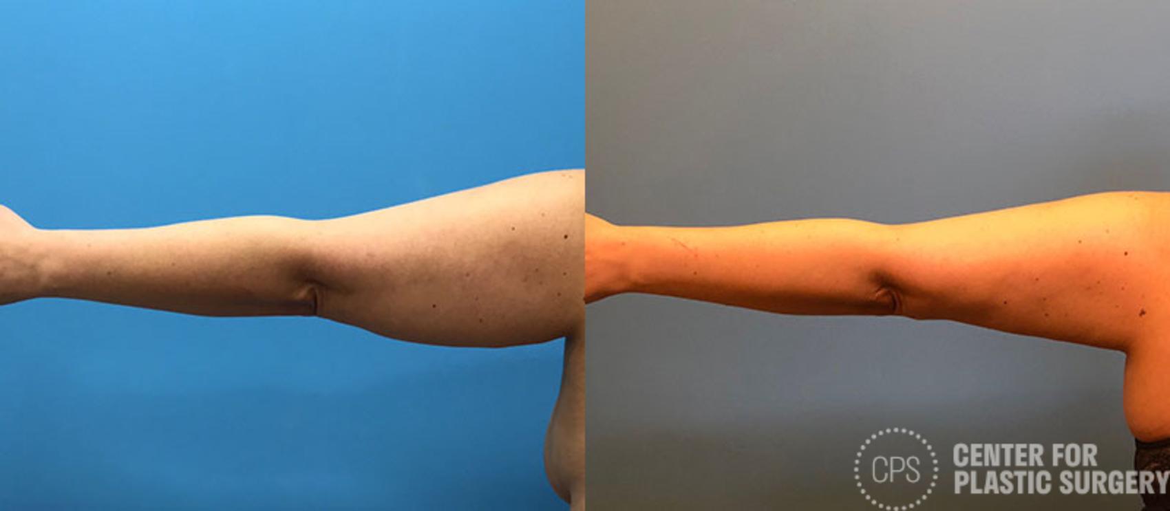 Liposuction Case 78 Before & After Left Arm, Back | Chevy Chase & Annandale, Washington D.C. Metropolitan Area | Center for Plastic Surgery