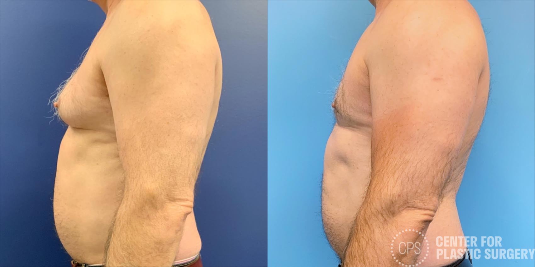 Male Breast Reduction / Gynecomastia Case 200 Before & After Right Side | Chevy Chase & Annandale, Washington D.C. Metropolitan Area | Center for Plastic Surgery