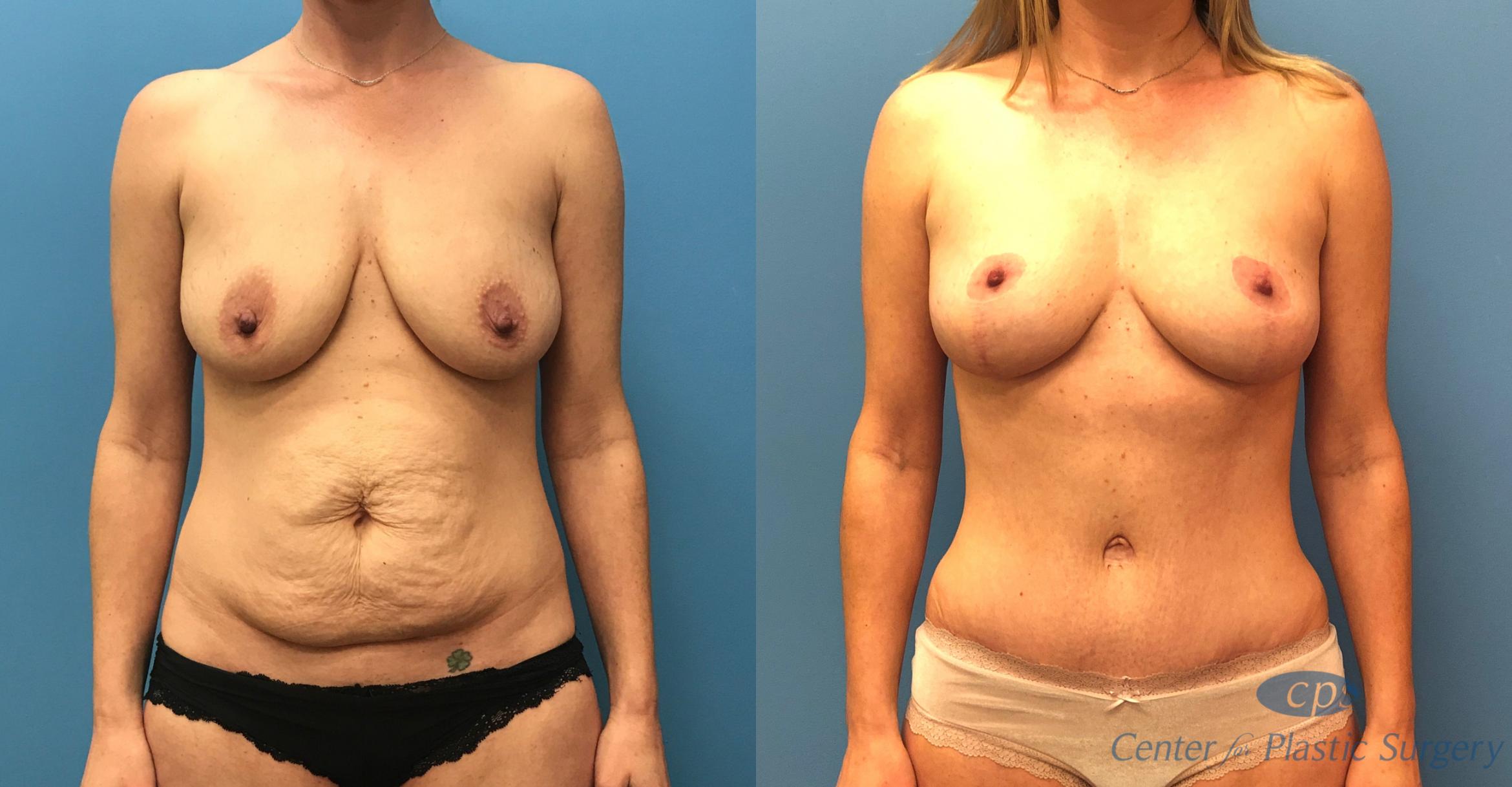 Mommy Makeover Before & After Photo | Annandale, Virginia | Center for Plastic Surgery
