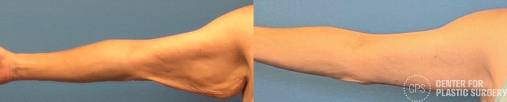 Arm Lift Case 208 Before & After Front | Chevy Chase & Annandale, Washington D.C. Metropolitan Area | Center for Plastic Surgery