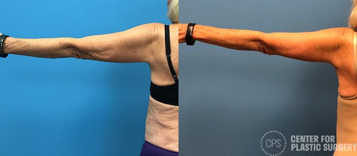 Arm Lift Case 80 Before & After Left Arm, Back | Chevy Chase & Annandale, Washington D.C. Metropolitan Area | Center for Plastic Surgery