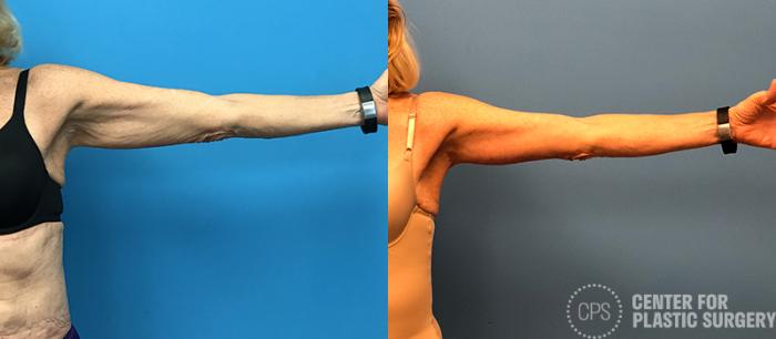 Arm Lift Case 80 Before & After Left Arm, Front | Chevy Chase & Annandale, Washington D.C. Metropolitan Area | Center for Plastic Surgery