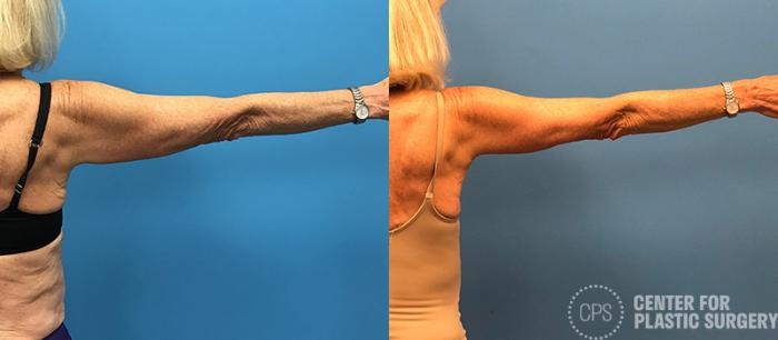 Arm Lift Case 80 Before & After Right Arm, Back | Chevy Chase & Annandale, Washington D.C. Metropolitan Area | Center for Plastic Surgery