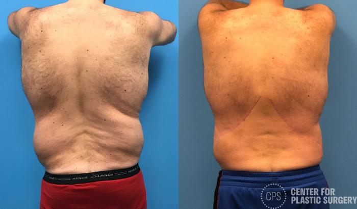 Liposuction Case 170 Before & After Back | Chevy Chase & Annandale, Washington D.C. Metropolitan Area | Center for Plastic Surgery