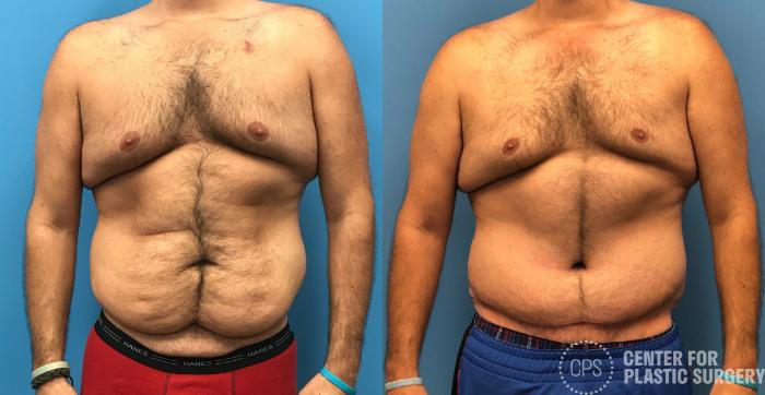 Liposuction Case 170 Before & After Front | Chevy Chase & Annandale, Washington D.C. Metropolitan Area | Center for Plastic Surgery