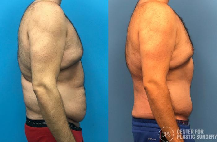 Liposuction Case 170 Before & After Right Side | Chevy Chase & Annandale, Washington D.C. Metropolitan Area | Center for Plastic Surgery