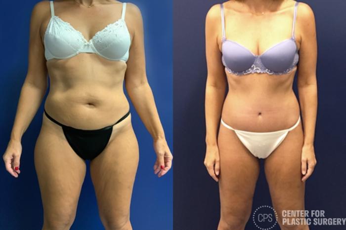 Thigh Lift Case 197 Before & After Front | Chevy Chase & Annandale, Washington D.C. Metropolitan Area | Center for Plastic Surgery