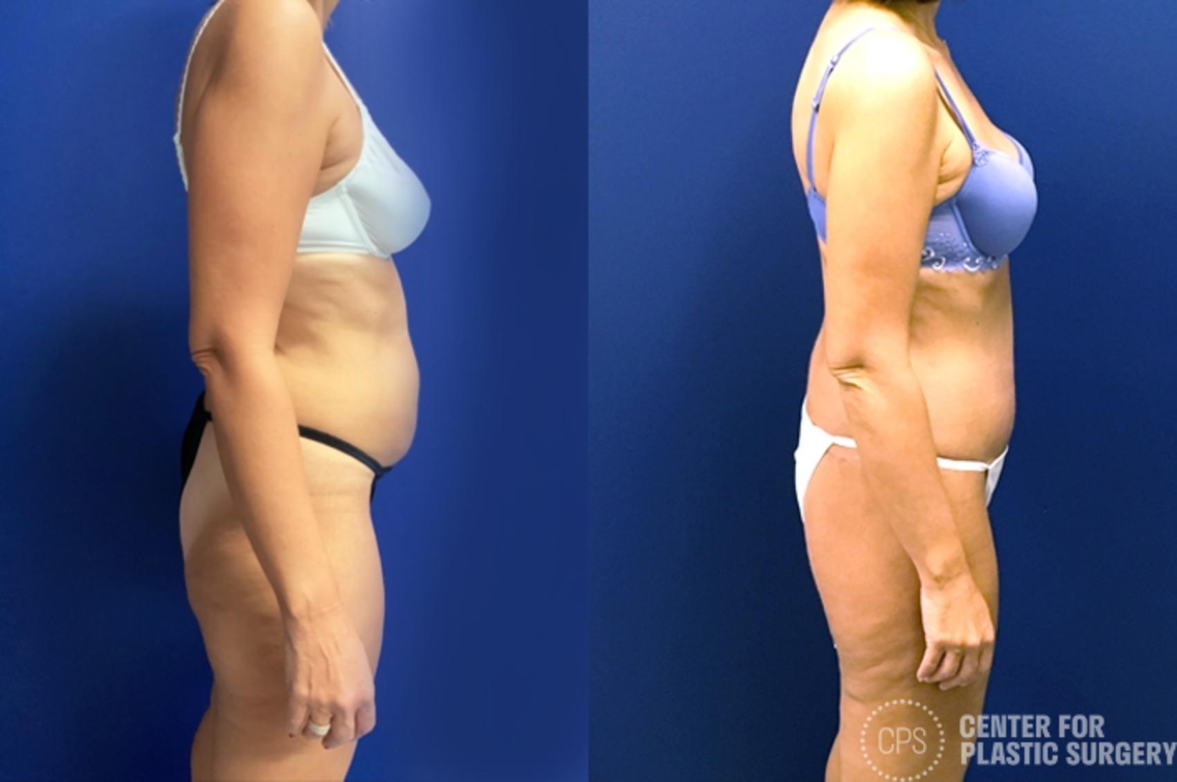 Body Lift Case 197 Before & After Right Side | Annandale, Washington D.C. Metropolitan Area | Center for Plastic Surgery