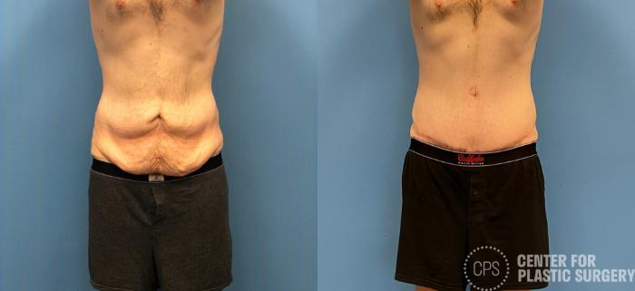 Tummy Tuck Case 273 Before & After Front | Chevy Chase & Annandale, Washington D.C. Metropolitan Area | Center for Plastic Surgery