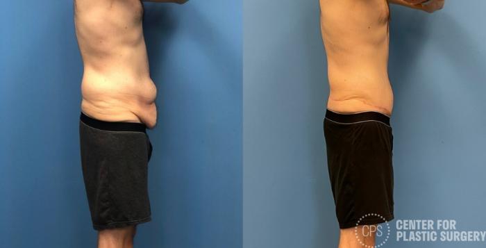Tummy Tuck Case 273 Before & After Right Side | Chevy Chase & Annandale, Washington D.C. Metropolitan Area | Center for Plastic Surgery