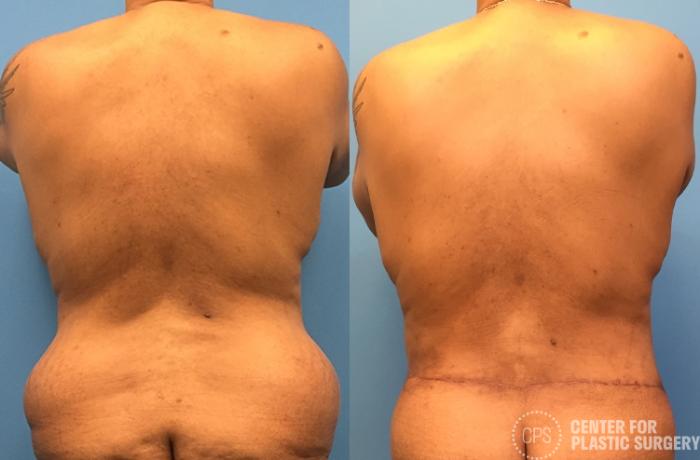 Body Lift Case 77 Before & After Back | Chevy Chase & Annandale, Washington D.C. Metropolitan Area | Center for Plastic Surgery