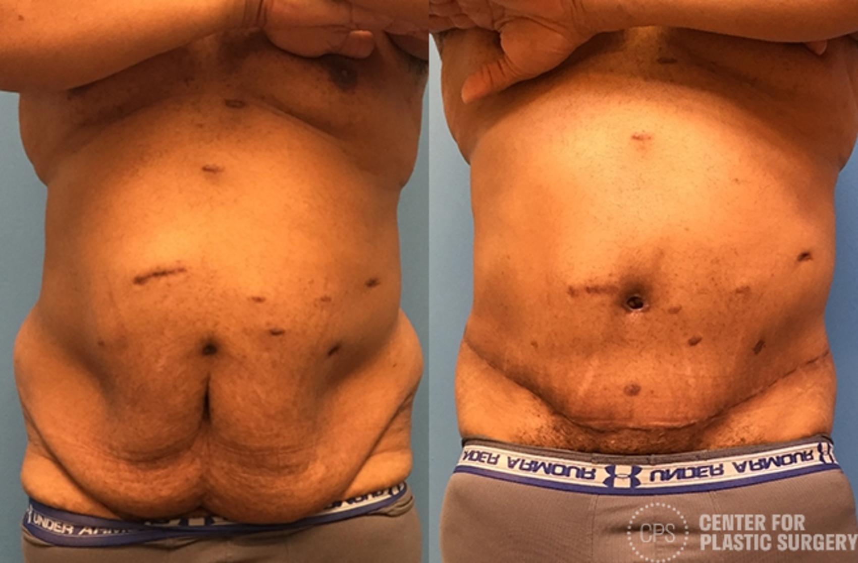 CoolSculpting® in Washington, DC, for Chevy Chase, MD & Arlington, VA