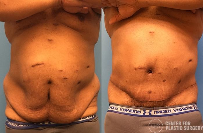 Body Lift Case 77 Before & After Front | Chevy Chase & Annandale, Washington D.C. Metropolitan Area | Center for Plastic Surgery