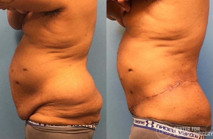 Body Lift Case 77 Before & After Left Side | Chevy Chase & Annandale, Washington D.C. Metropolitan Area | Center for Plastic Surgery