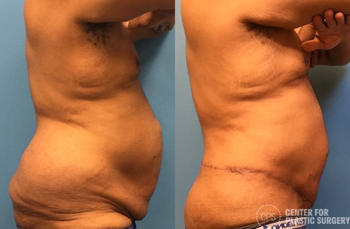 Body Lift Case 77 Before & After Right Side | Chevy Chase & Annandale, Washington D.C. Metropolitan Area | Center for Plastic Surgery