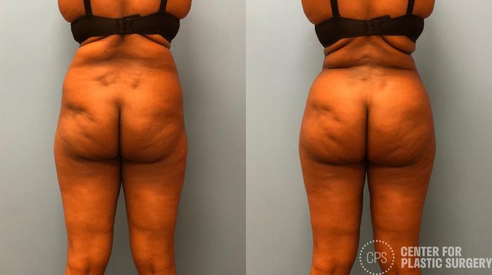 Brazilian Butt Lift Case 180 Before & After Back | Chevy Chase & Annandale, Washington D.C. Metropolitan Area | Center for Plastic Surgery