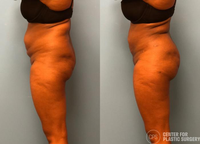 Brazilian Butt Lift Case 180 Before & After Left Side | Chevy Chase & Annandale, Washington D.C. Metropolitan Area | Center for Plastic Surgery