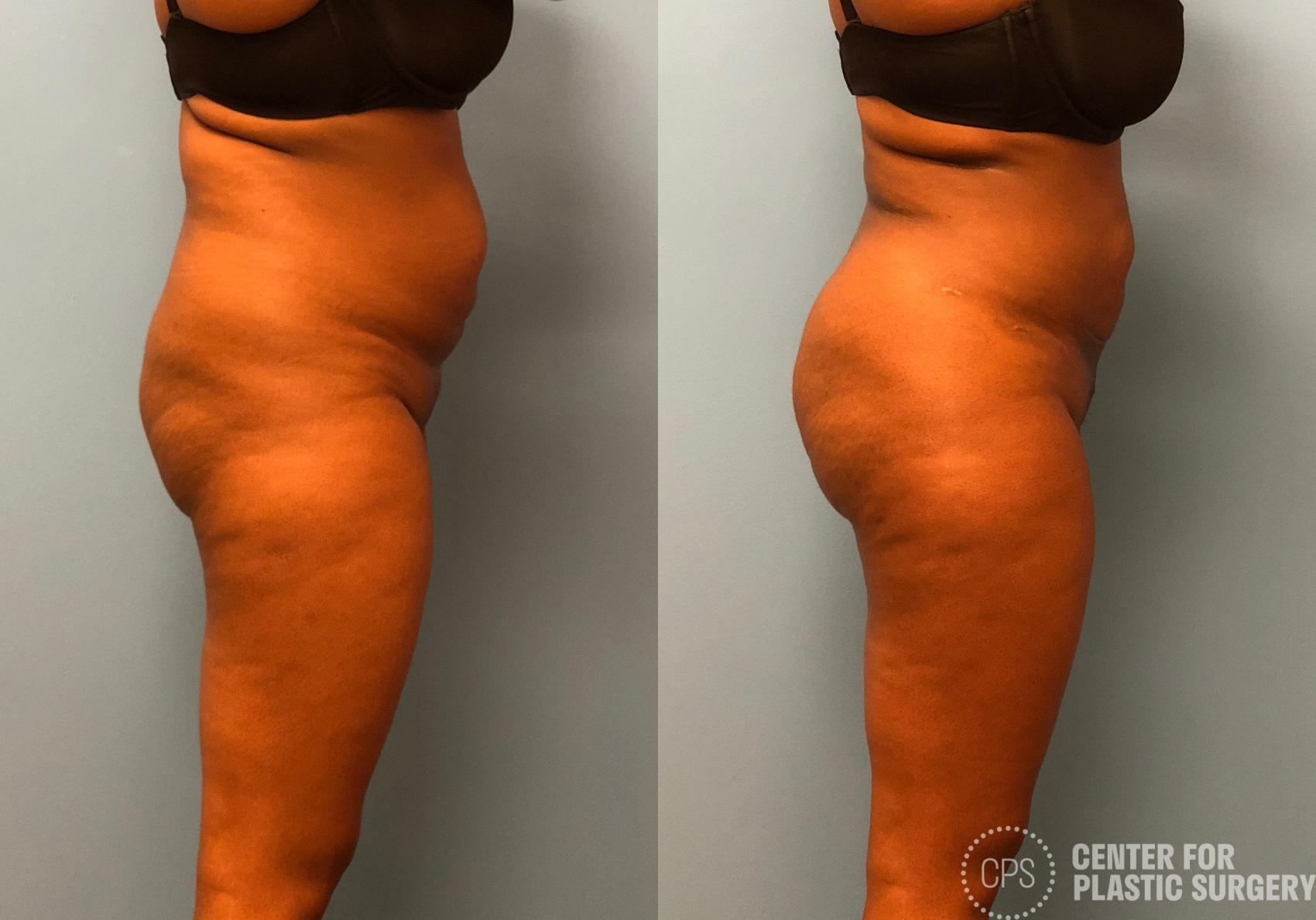 Liposuction Case 180 Before & After Right Side Annandale, Washington D....