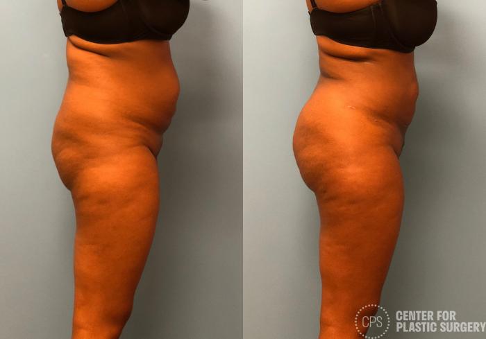 Brazilian Butt Lift Case 180 Before & After Right Side | Chevy Chase & Annandale, Washington D.C. Metropolitan Area | Center for Plastic Surgery