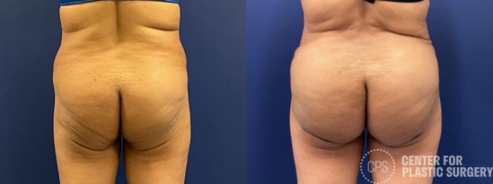 Brazilian Butt Lift Case 215 Before & After Front | Chevy Chase & Annandale, Washington D.C. Metropolitan Area | Center for Plastic Surgery
