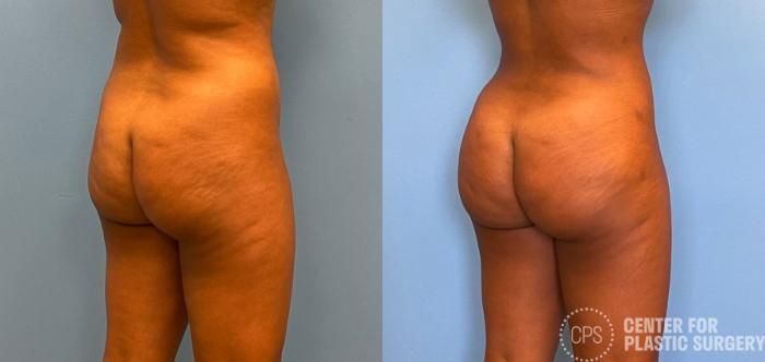 Brazilian Butt Lift Case 263 Before & After Right Oblique | Chevy Chase & Annandale, Washington D.C. Metropolitan Area | Center for Plastic Surgery