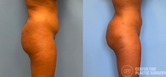 Brazilian Butt Lift Case 263 Before & After Right Side | Chevy Chase & Annandale, Washington D.C. Metropolitan Area | Center for Plastic Surgery