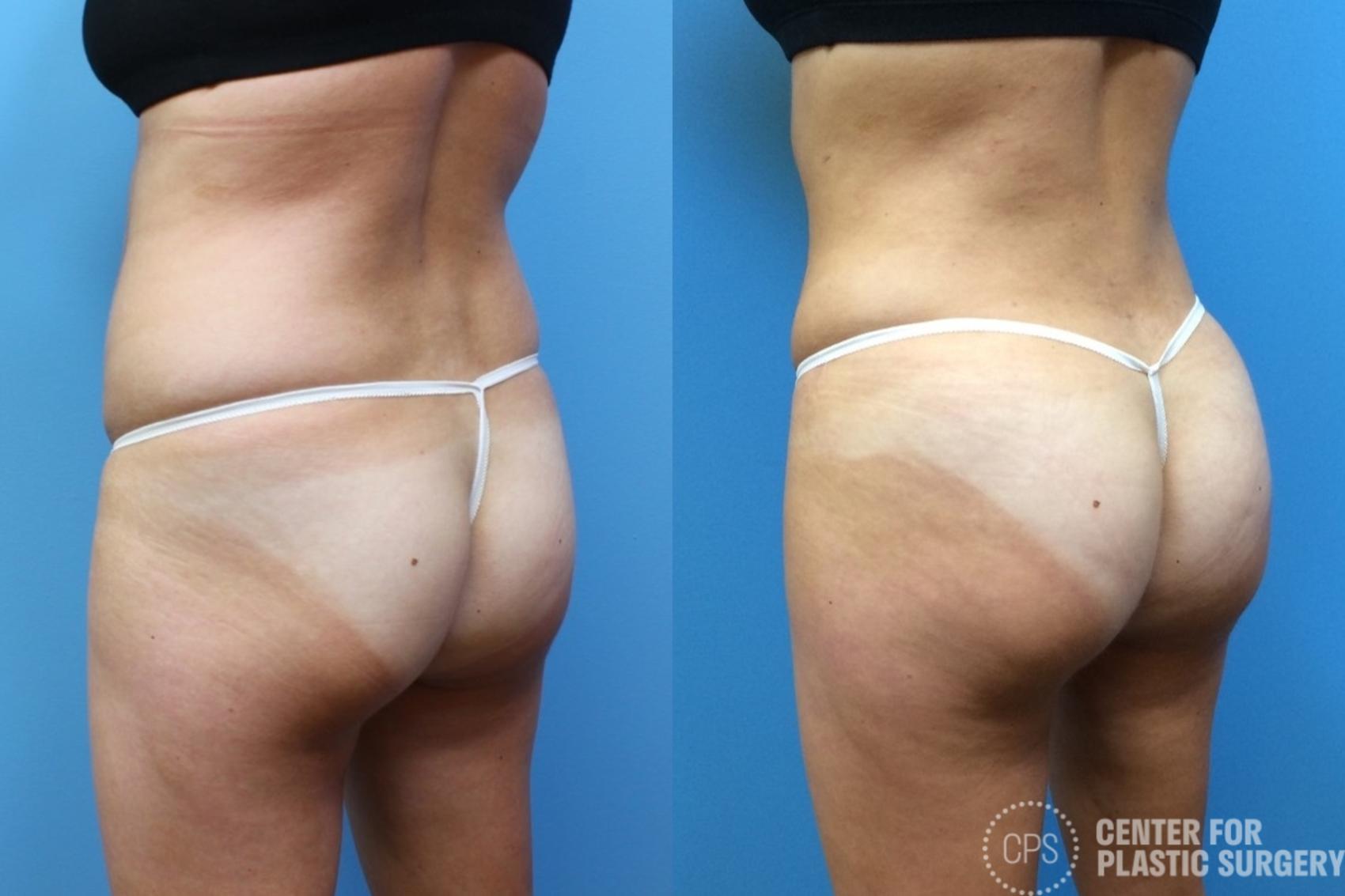 Brazilian Butt Lift Case 265 Before & After Left Oblique | Chevy Chase & Annandale, Washington D.C. Metropolitan Area | Center for Plastic Surgery