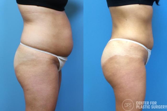 Brazilian Butt Lift Case 265 Before & After Right Side | Chevy Chase & Annandale, Washington D.C. Metropolitan Area | Center for Plastic Surgery