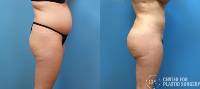Brazilian Butt Lift Case 266 Before & After Right Side | Chevy Chase & Annandale, Washington D.C. Metropolitan Area | Center for Plastic Surgery