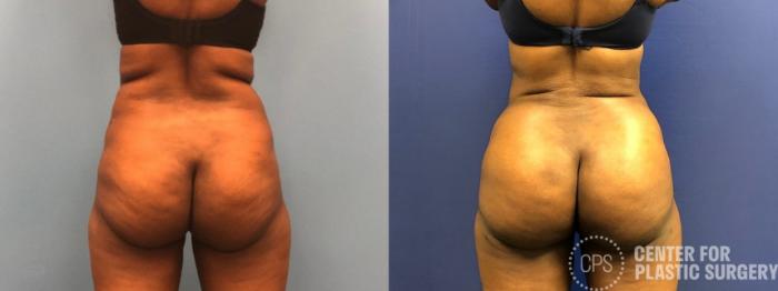 Brazilian Butt Lift Case 267 Before & After Back | Chevy Chase & Annandale, Washington D.C. Metropolitan Area | Center for Plastic Surgery