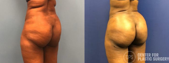 Brazilian Butt Lift Case 267 Before & After Left Oblique | Chevy Chase & Annandale, Washington D.C. Metropolitan Area | Center for Plastic Surgery