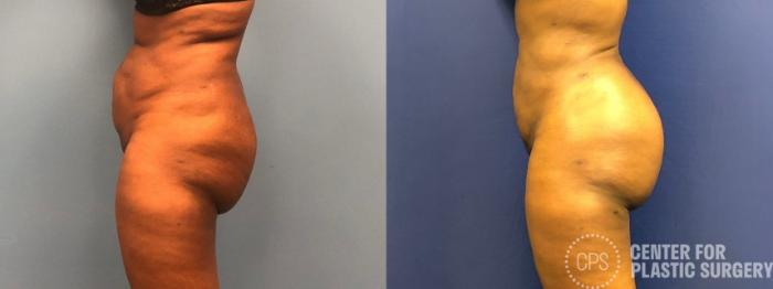 Brazilian Butt Lift Case 267 Before & After Left Side | Chevy Chase & Annandale, Washington D.C. Metropolitan Area | Center for Plastic Surgery