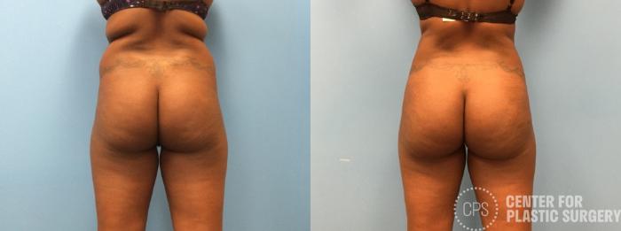 Brazilian Butt Lift Case 271 Before & After Back | Chevy Chase & Annandale, Washington D.C. Metropolitan Area | Center for Plastic Surgery