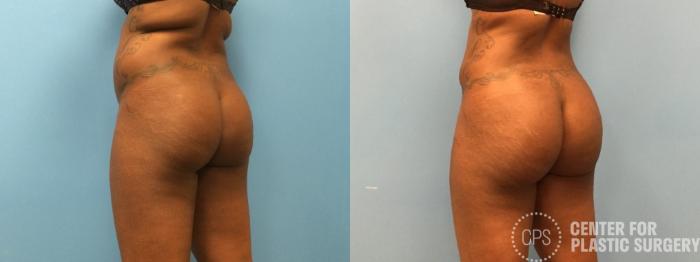 Brazilian Butt Lift Case 271 Before & After Left Oblique | Chevy Chase & Annandale, Washington D.C. Metropolitan Area | Center for Plastic Surgery