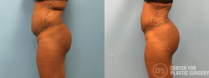 Brazilian Butt Lift Case 271 Before & After Left Side | Chevy Chase & Annandale, Washington D.C. Metropolitan Area | Center for Plastic Surgery