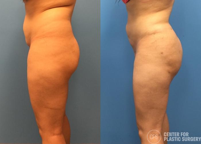 Brazilian Butt Lift Case 272 Before & After Left Side | Chevy Chase & Annandale, Washington D.C. Metropolitan Area | Center for Plastic Surgery