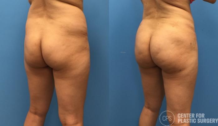 Brazilian Butt Lift Case 272 Before & After Right Oblique | Chevy Chase & Annandale, Washington D.C. Metropolitan Area | Center for Plastic Surgery