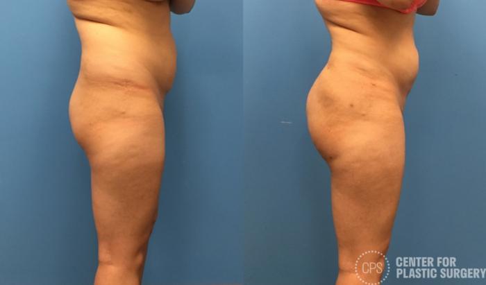 Brazilian Butt Lift Case 272 Before & After Right Side | Chevy Chase & Annandale, Washington D.C. Metropolitan Area | Center for Plastic Surgery
