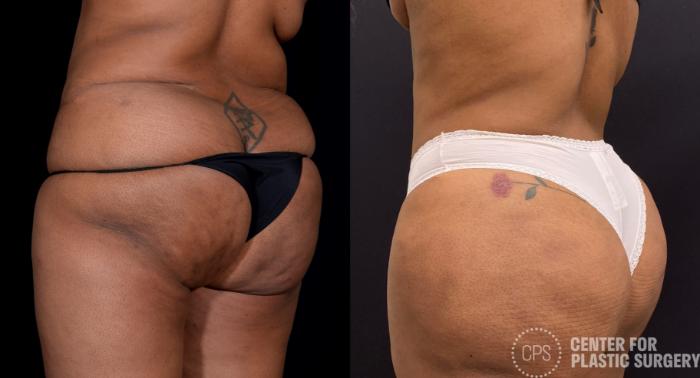 Brazilian Butt Lift Case 352 Before & After Left Oblique | Chevy Chase & Annandale, Washington D.C. Metropolitan Area | Center for Plastic Surgery