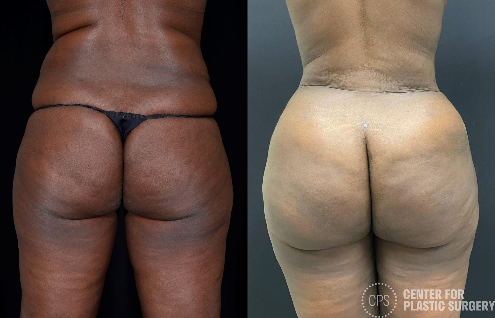 Brazilian Butt Lift Case 353 Before & After Back | Chevy Chase & Annandale, Washington D.C. Metropolitan Area | Center for Plastic Surgery