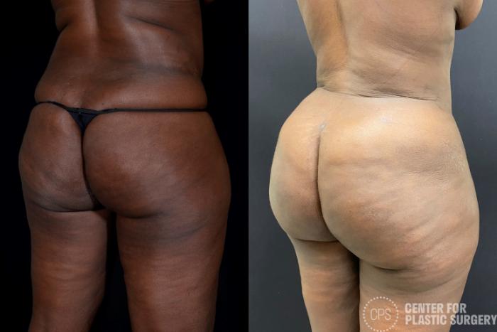Brazilian Butt Lift Case 353 Before & After Right Oblique | Chevy Chase & Annandale, Washington D.C. Metropolitan Area | Center for Plastic Surgery