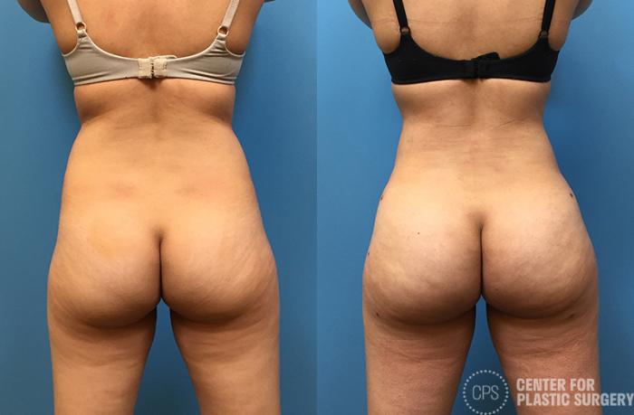 Brazilian Butt Lift Case 73 Before & After Back | Chevy Chase & Annandale, Washington D.C. Metropolitan Area | Center for Plastic Surgery